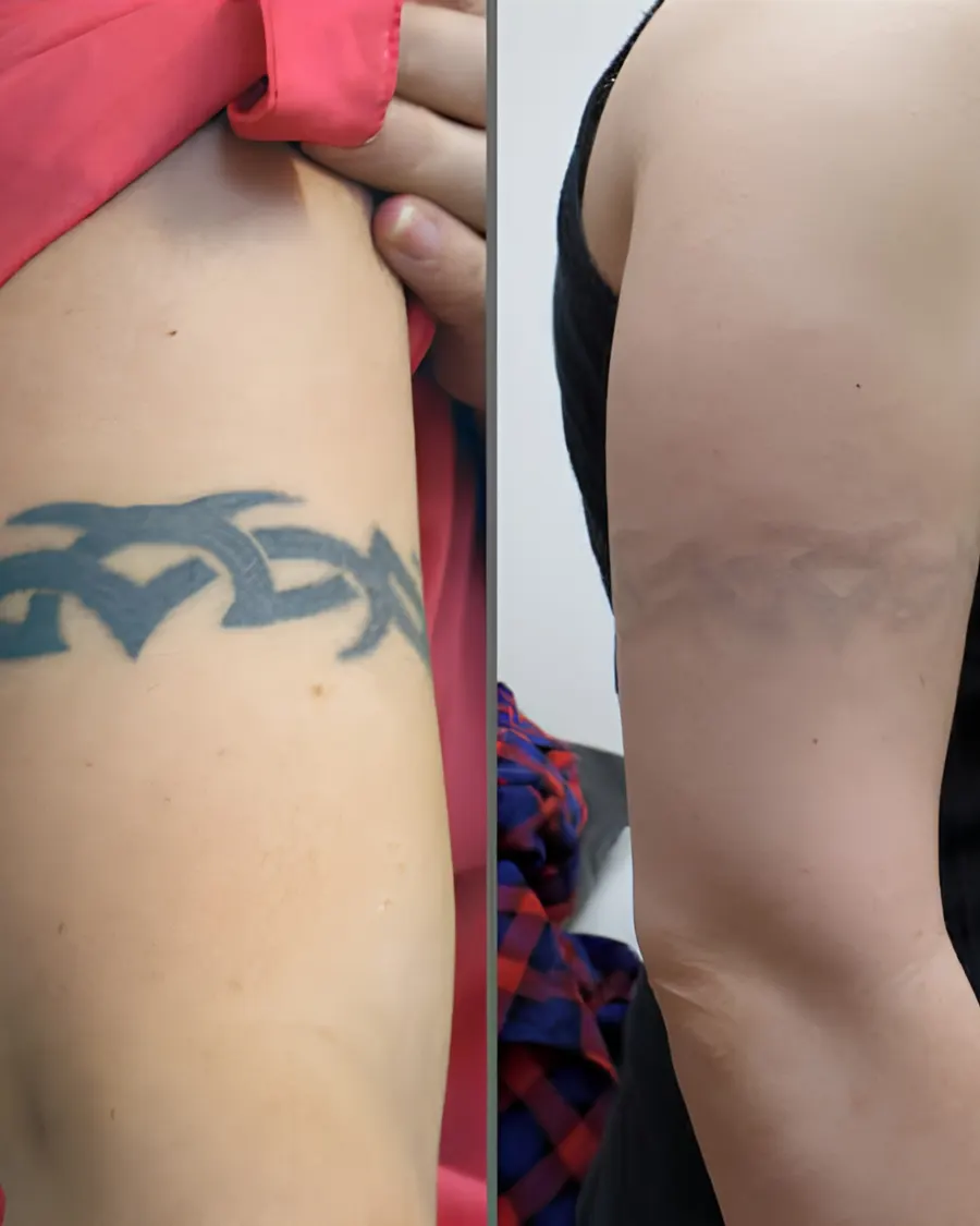 Advanced Laser Tattoo Removal Technology at Cinch Clinics